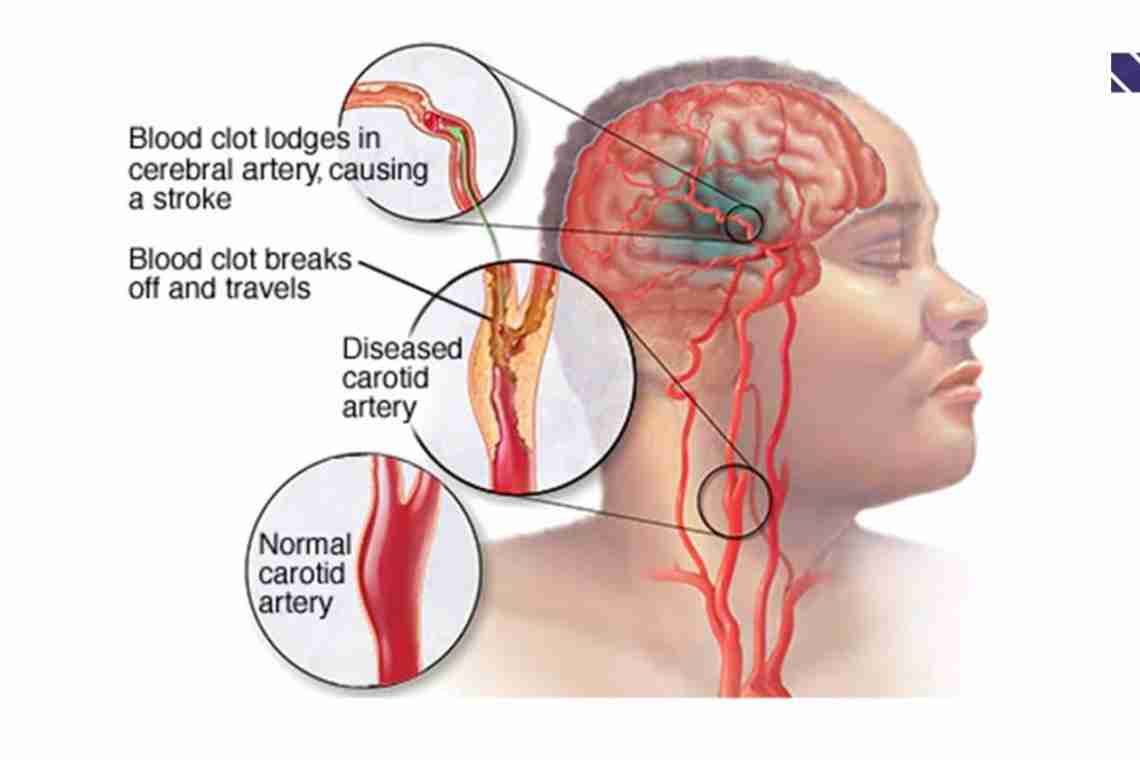 Последствия инсульта правой стороны головного мозга